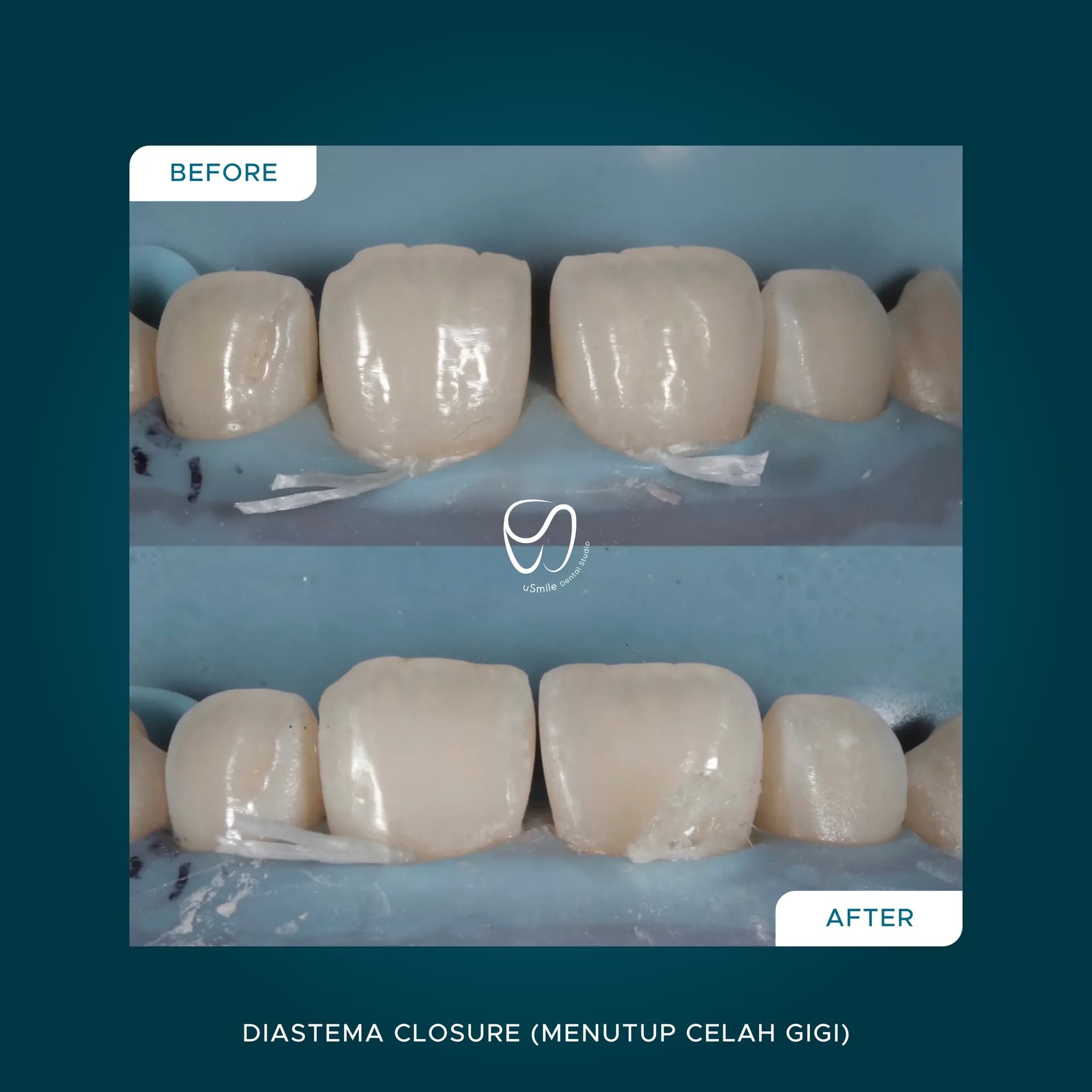 Penutupan Celah Gigi Depan (Diastema)