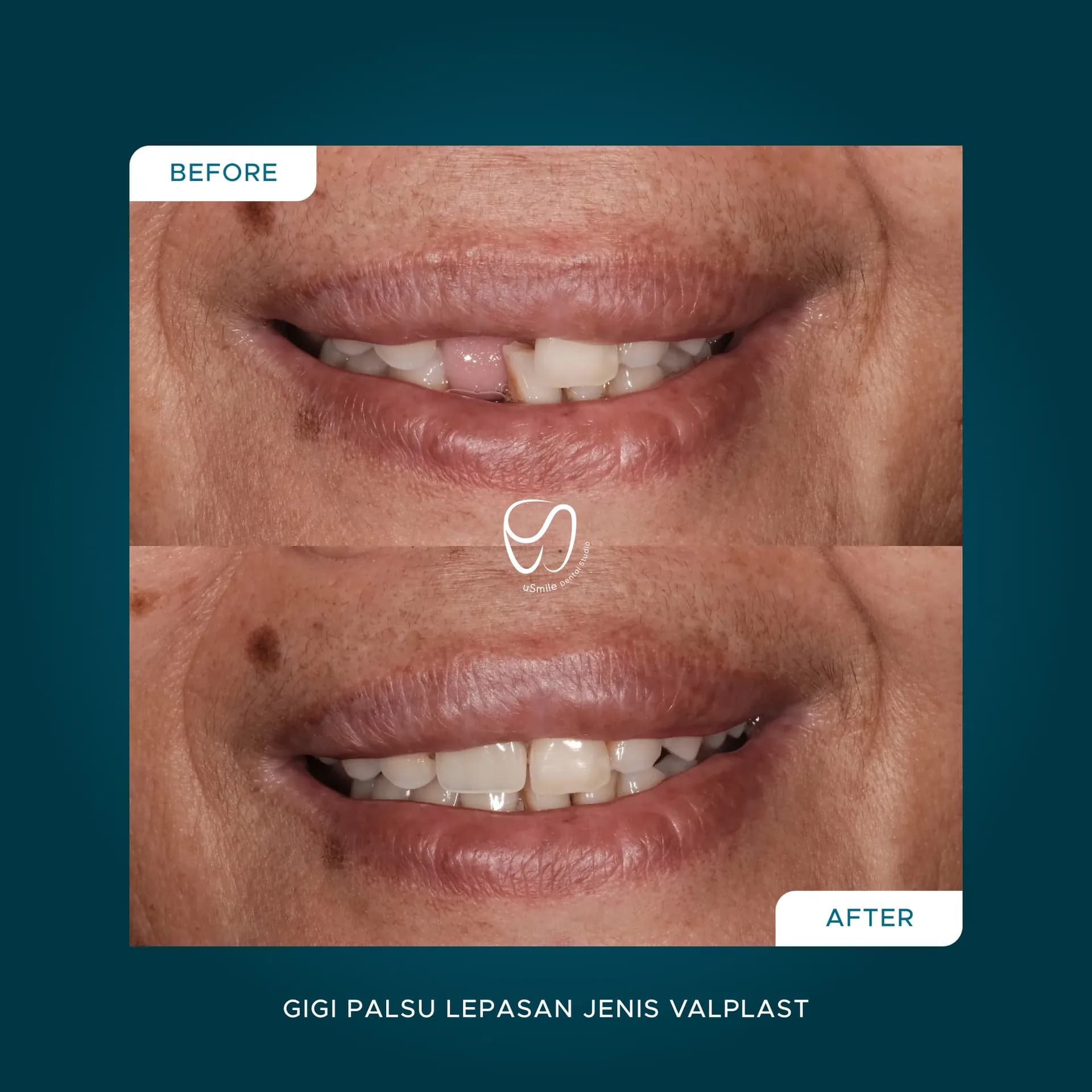 Gigi Tiruan Lepasan Valplast