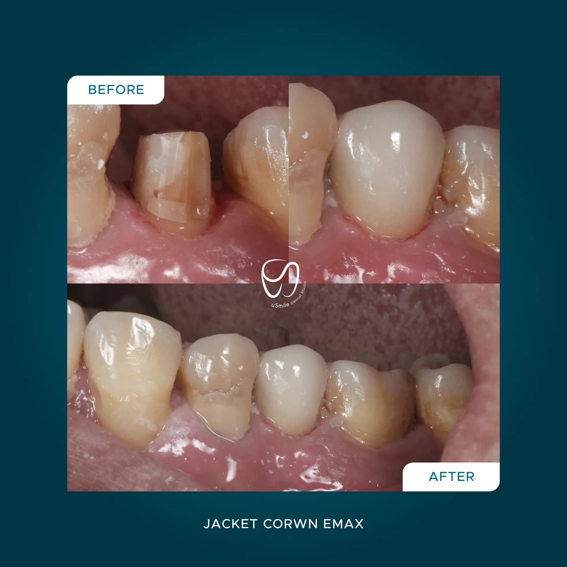 Jacket Crown E-Max Estetik