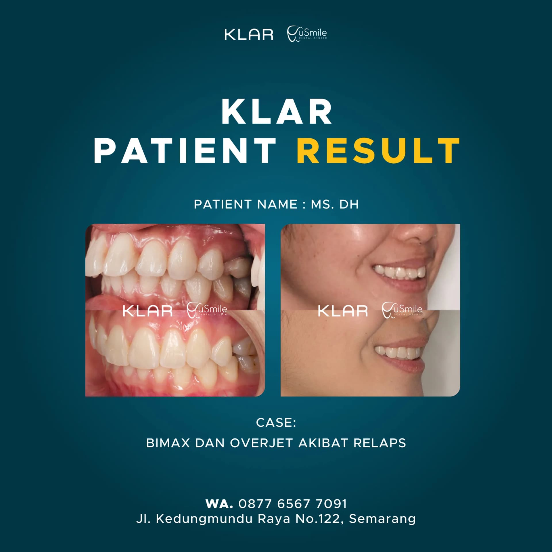 Clear Aligner Koreksi Bimax Overjet