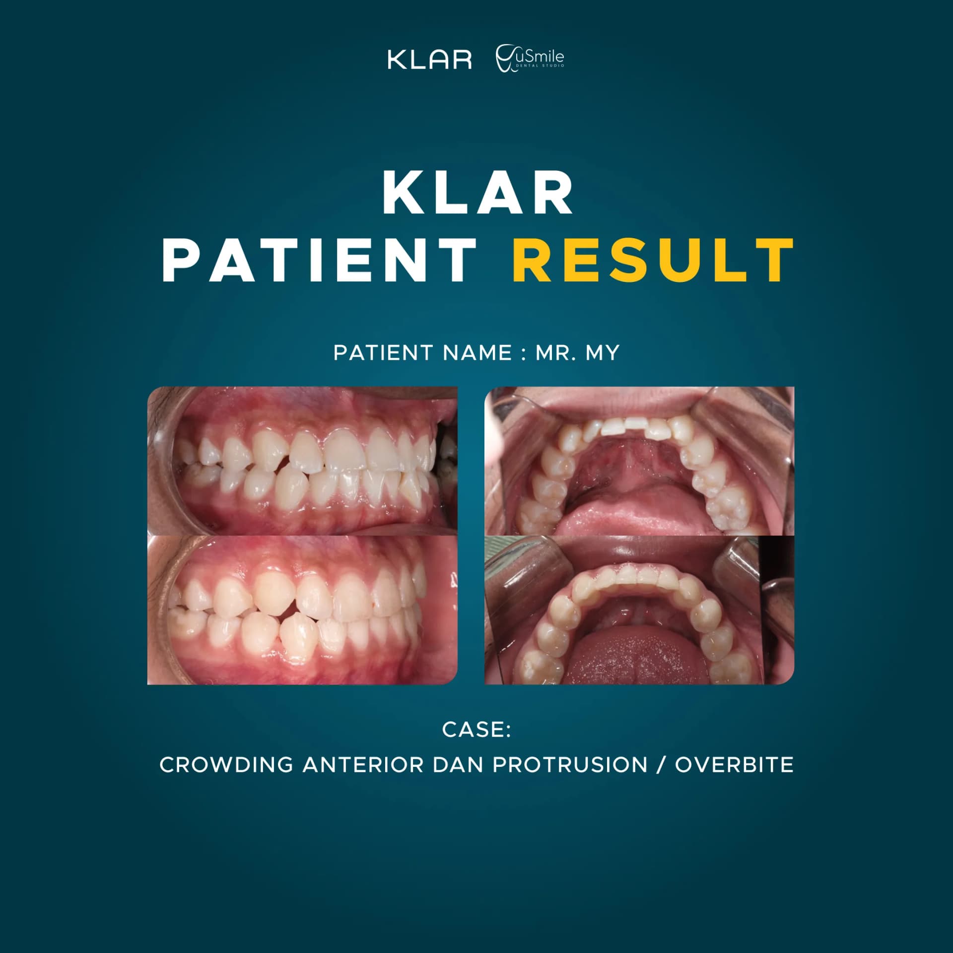 Clear Aligner Koreksi Crowding & Overbite