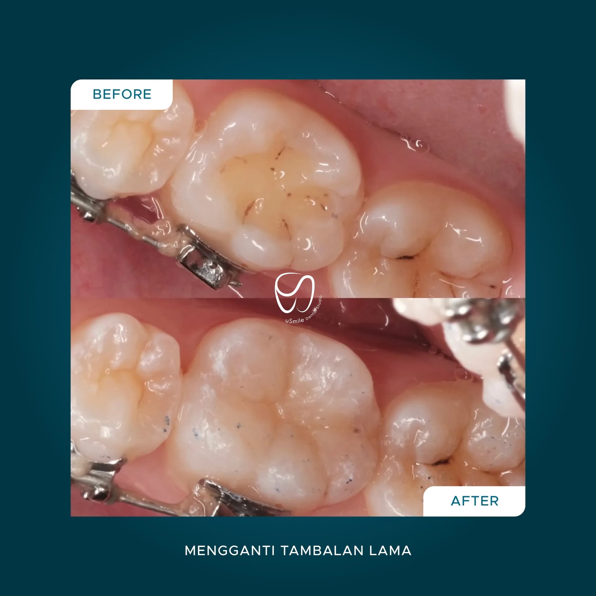Penggantian Tambalan Lama