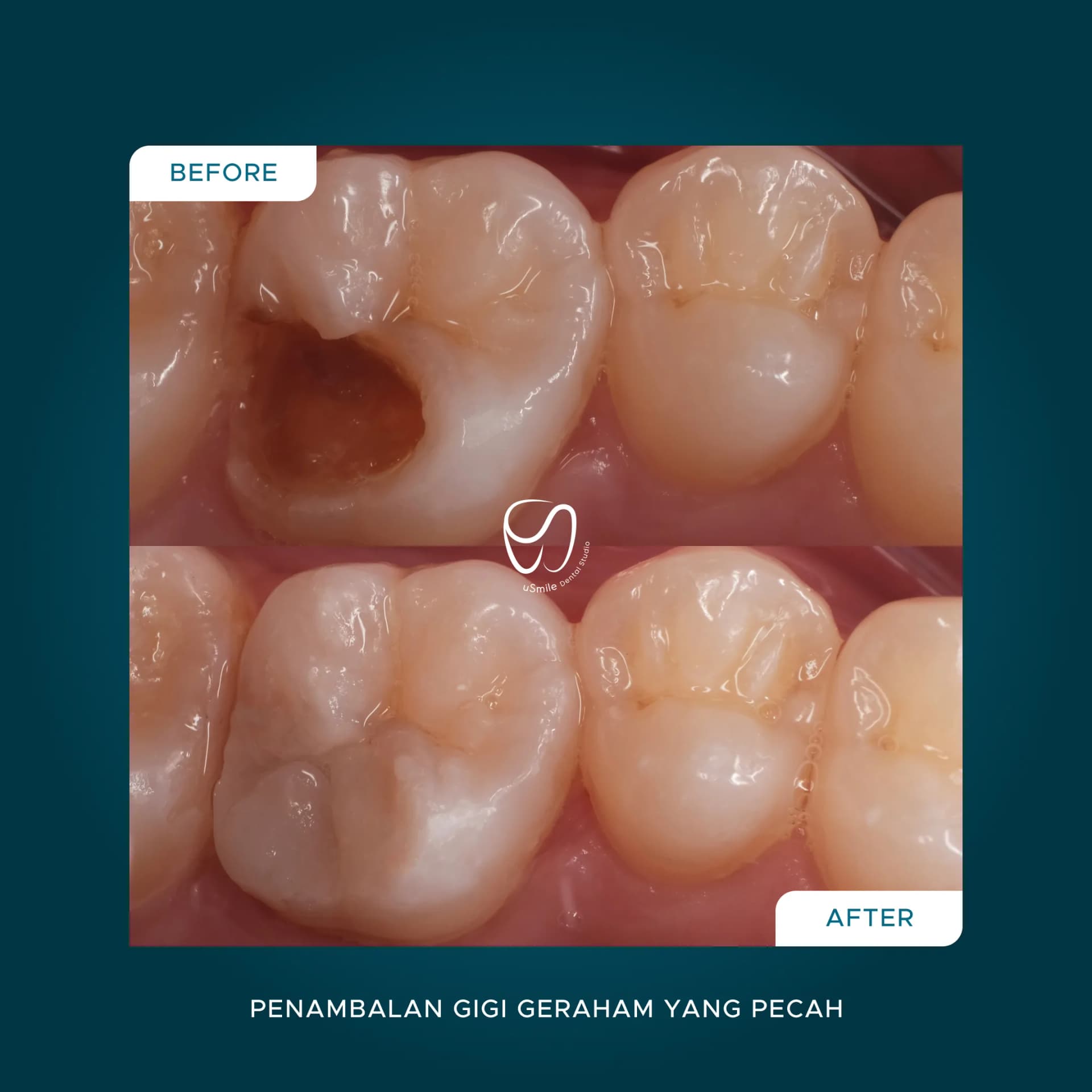 Restorasi Gigi Geraham Pecah