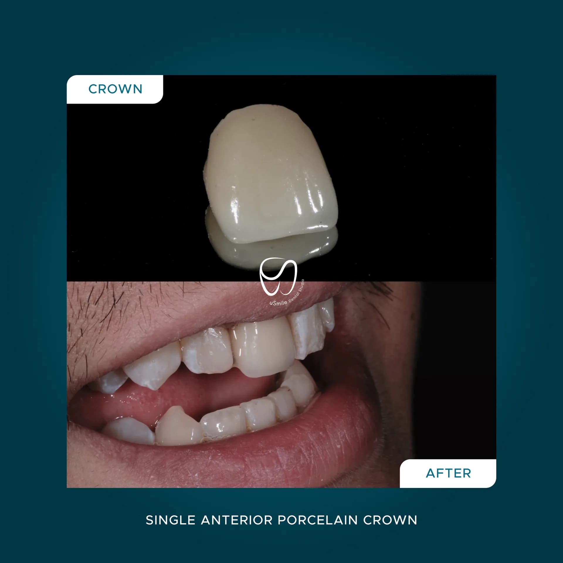 Single Anterior Porcelain Crown