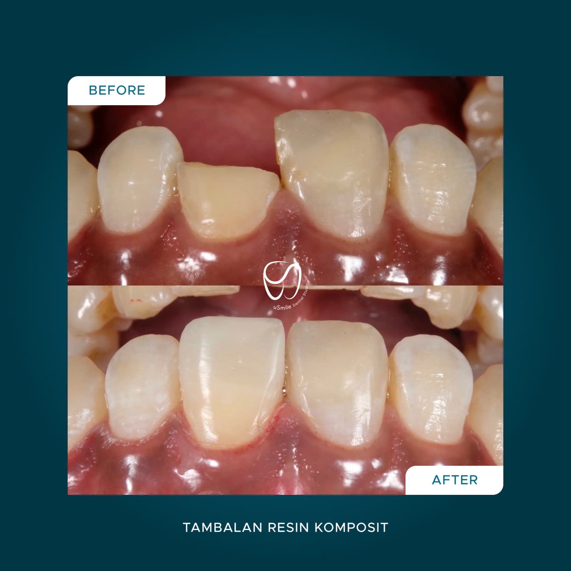 Tambalan Resin Komposit Gigi Depan