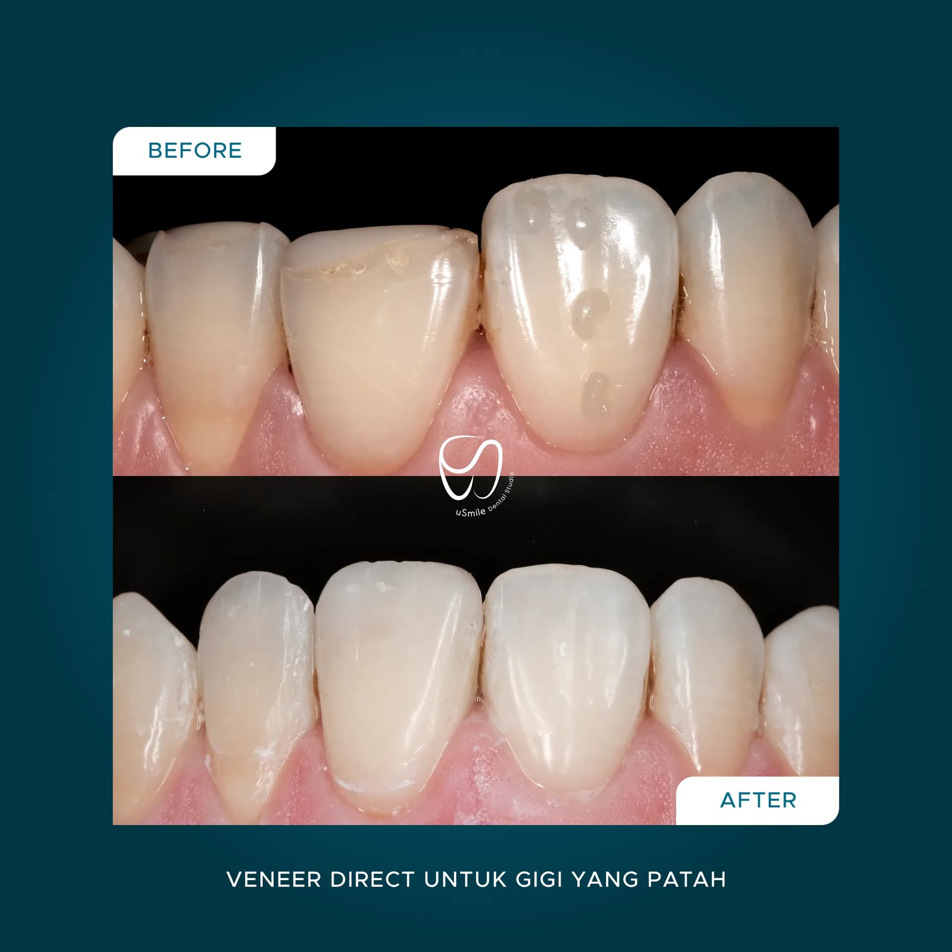 Veneer Direct pada Gigi Patah