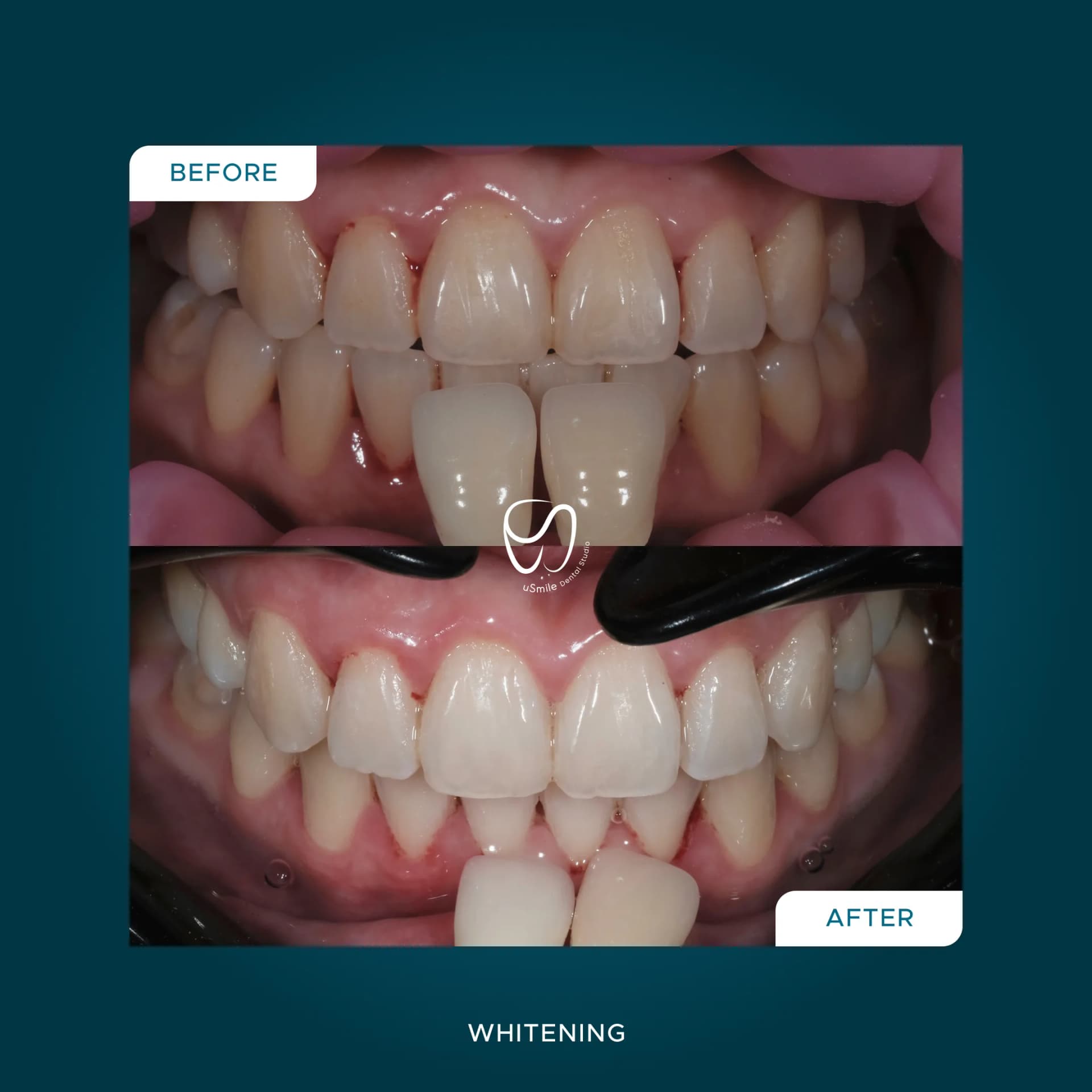 Pemutihan Gigi (Whitening)